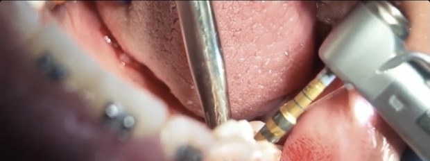 Guided implant placement in the surgical suite