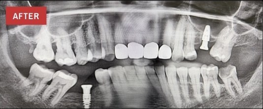 Post-op panoramic