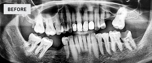 Pre-op panoramic